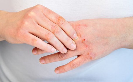 乳膠手套能否有效防止長(zhǎng)水泡？